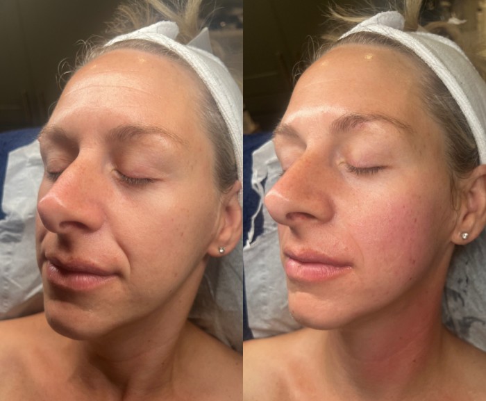 EndyMed Skin Tightening Before & After in Essex