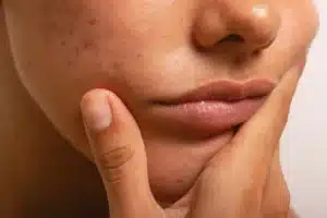 Melasma Treatments in Exeter Devon