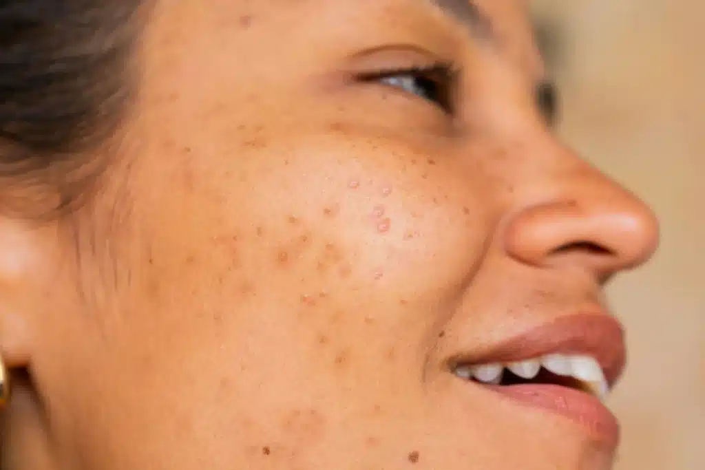 A woman with Acne Scarring in Devon